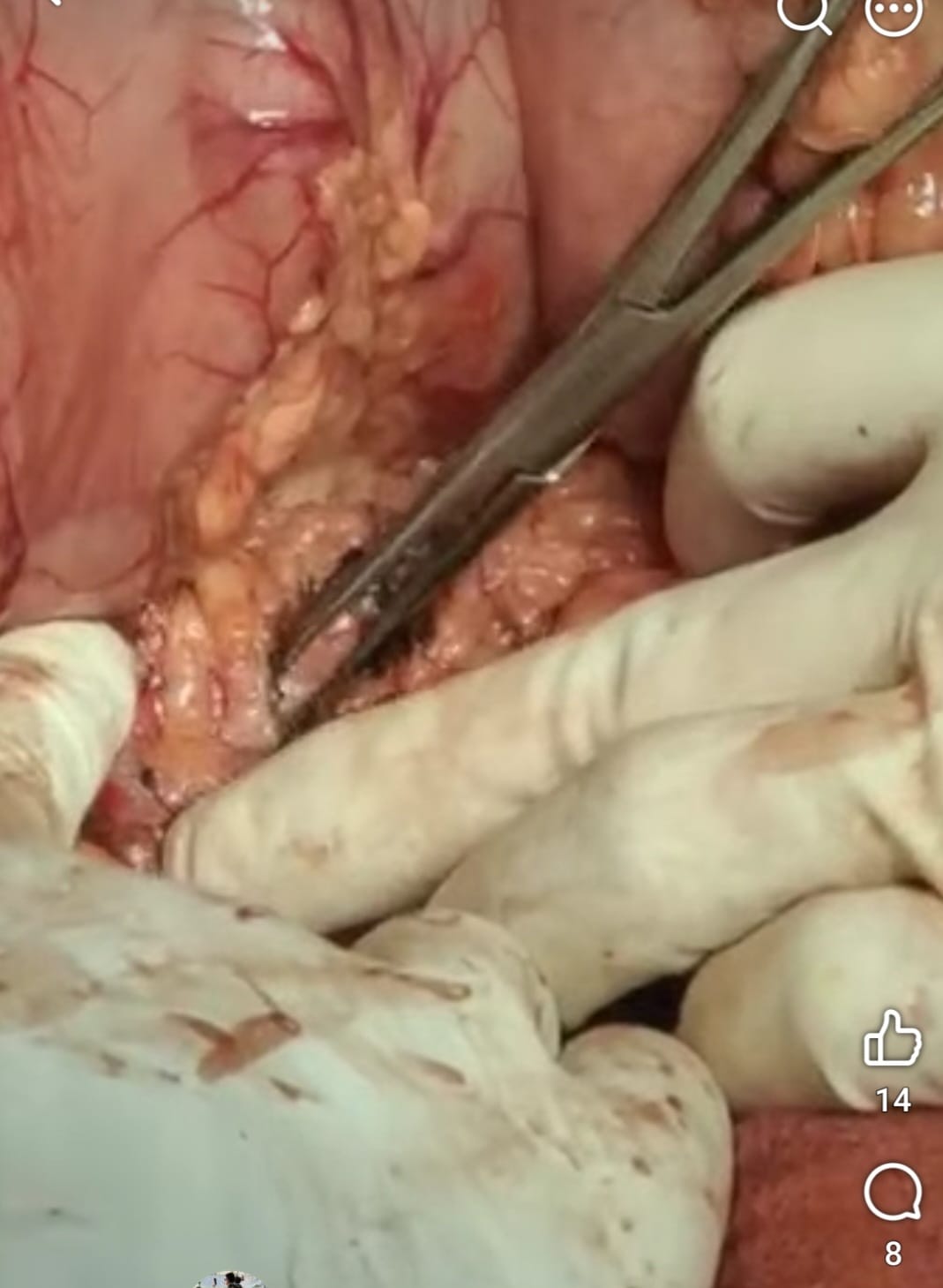 Dr Raman Garg performing lateral pancreaticojejunostomy during Frey's Procedure