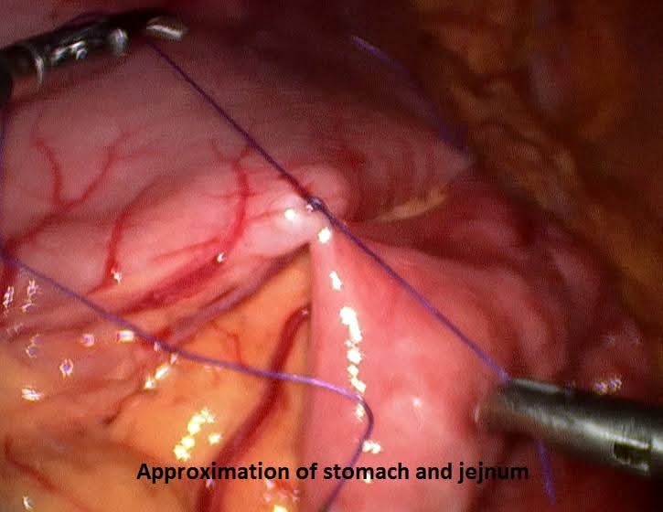 Laparoscopic approximation of stomach and jejunum before gastrojejunostomy