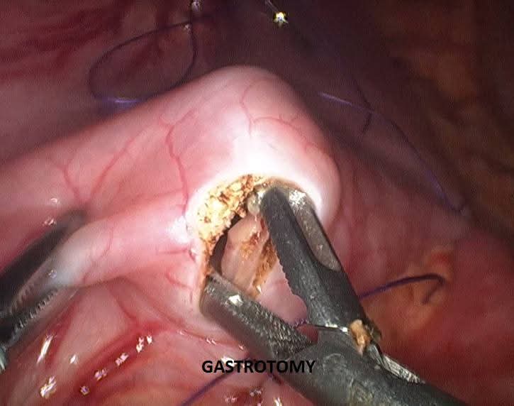 Laparoscopic gastrotomy performed during gastrojejunostomy