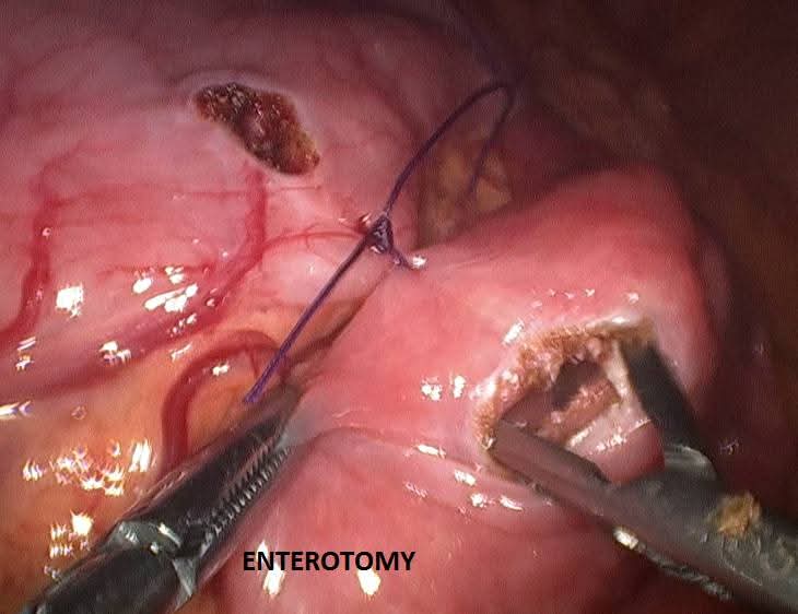 Laparoscopic enterotomy performed on the jejunum