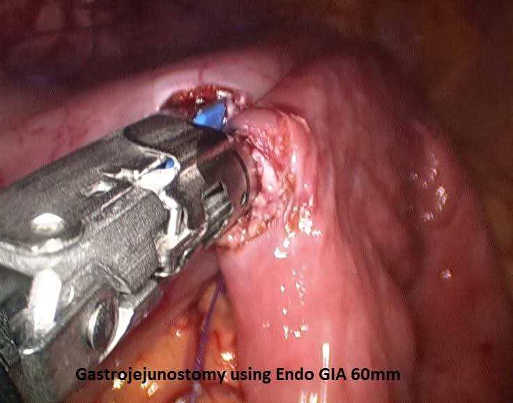 Laparoscopic Gastrojejunostomy for Benign Gastric Outlet Obstruction