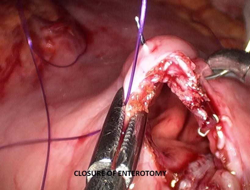 Laparoscopic closure of the enterotomy after stapling