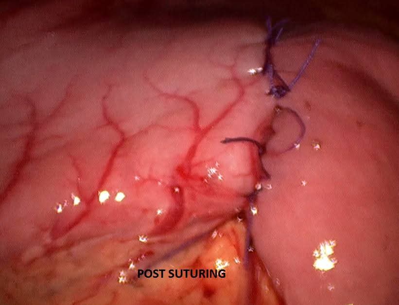 Completed laparoscopic suturing after gastrojejunostomy