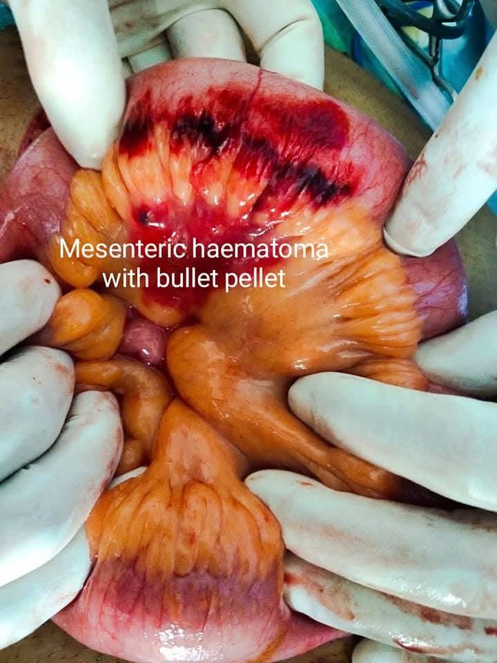 Emergency Surgery for Gunshot Injury with Small Bowel Perforation Successfully Managed by Dr. Raman Garg
