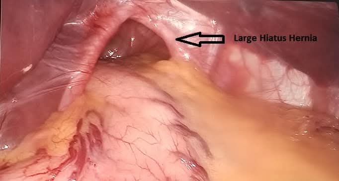 Laparoscopic Hiatus Hernia Repair with Floppy Nissen Fundoplication Successfully Performed by Dr. Raman Garg