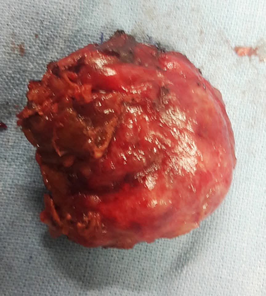 Complex Liver Hydatid Cyst with Cystobiliary Communication Successfully Managed After Failed Endoscopic Treatment