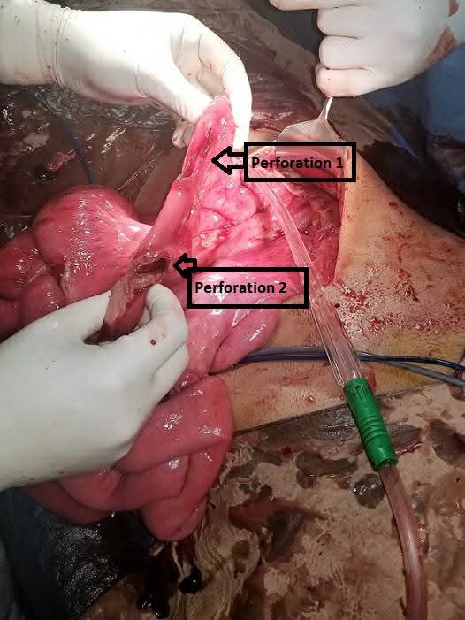 Life-Saving Emergency Surgery for Multiple Ileal Perforations with Septic Shock Successfully Performed by Dr. Raman Garg
