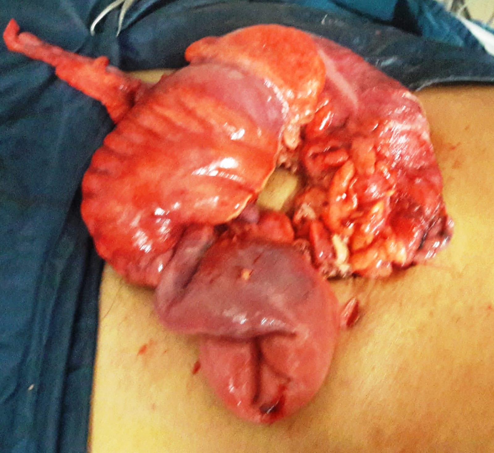 Laparoscopic-Assisted Right Hemicolectomy for Adult Ileocolic Intussusception Caused by Ileal Lipoma