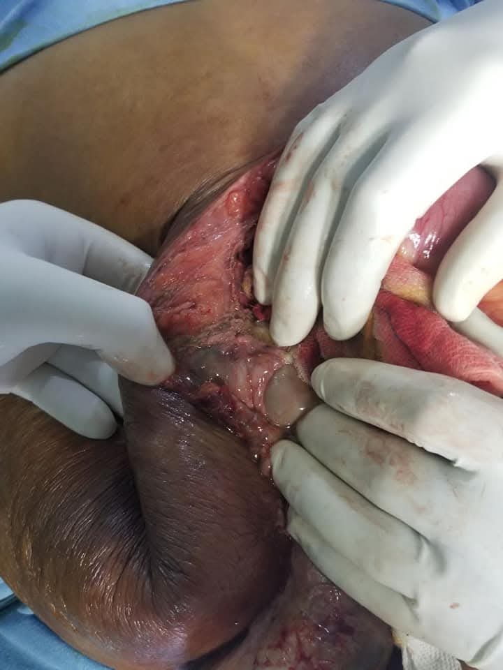 Strangulated Recurrent Incisional Hernia with Gangrenous Bowel Successfully Managed by Dr. Raman Garg