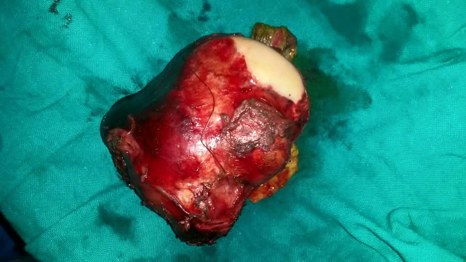 First Liver Resection for a Giant 15 x 15 cm Liver Cyst Performed in Bathinda
