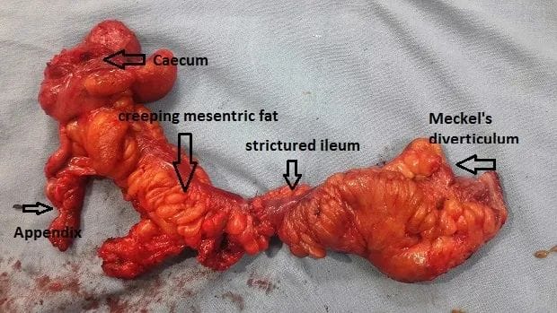 Rare Meckel's Diverticulitis with Terminal Ileal Stricture Successfully Managed by Dr. Raman Garg