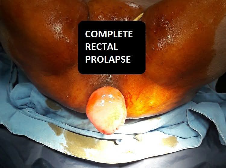 Perineal Proctosigmoidectomy (Altemeier's Procedure) for Complete Rectal Prolapse