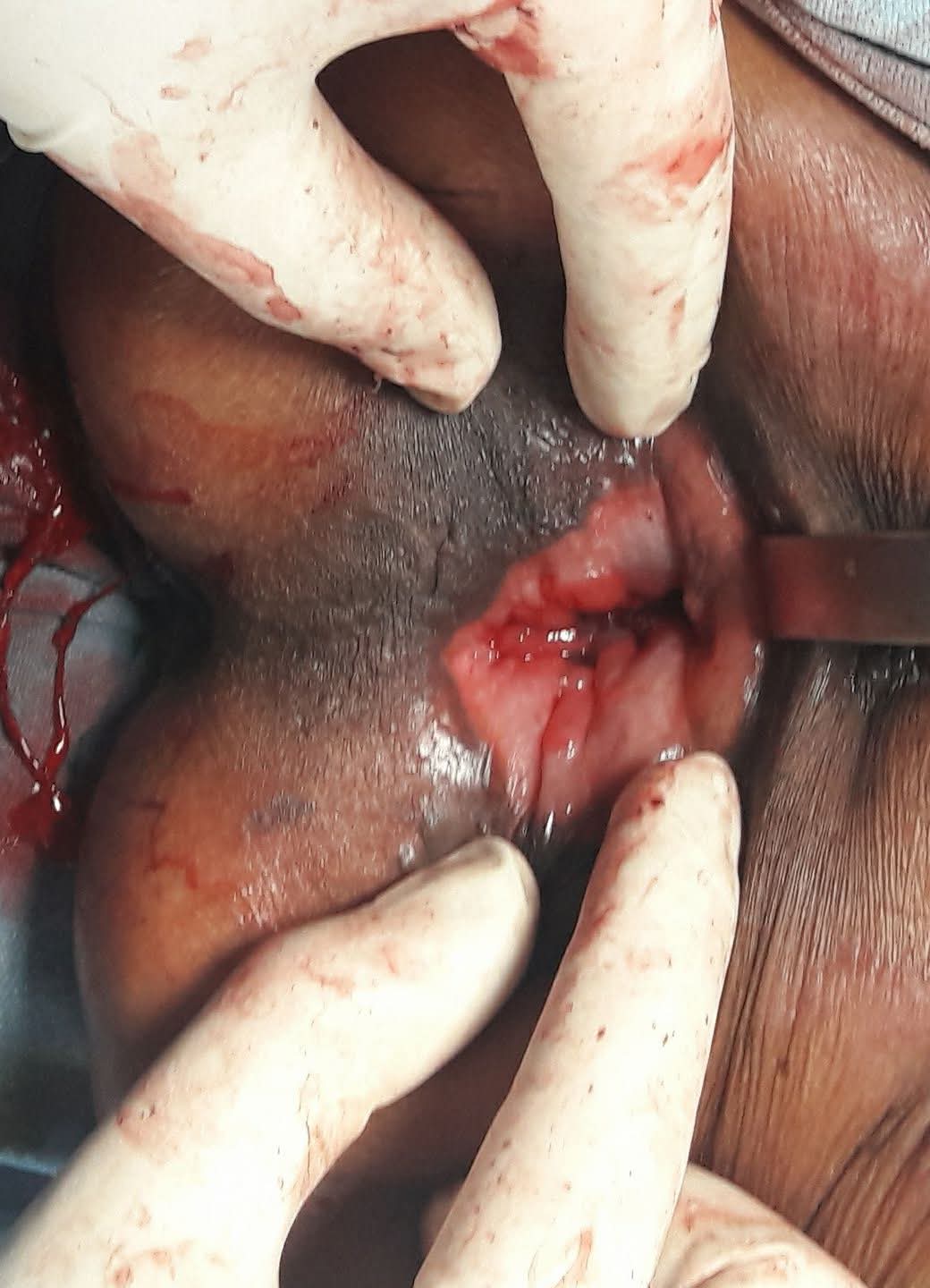 Perineal approach to the prolapsed rectum during Altemeier's procedure