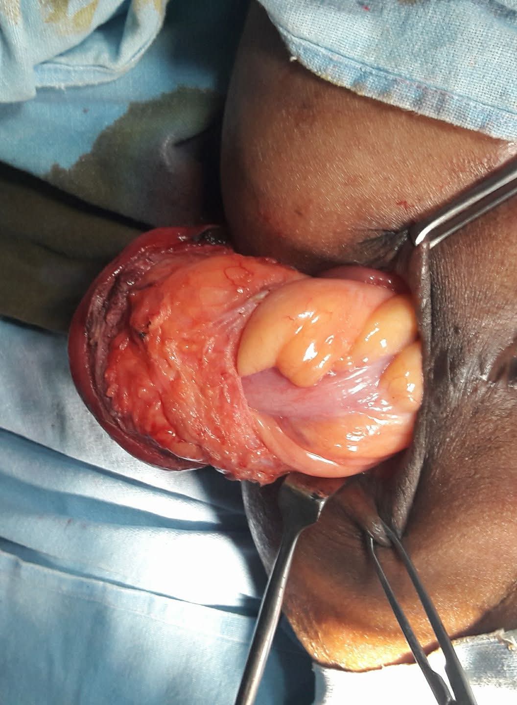 Prolapsed rectum being delivered through the perineum during surgery