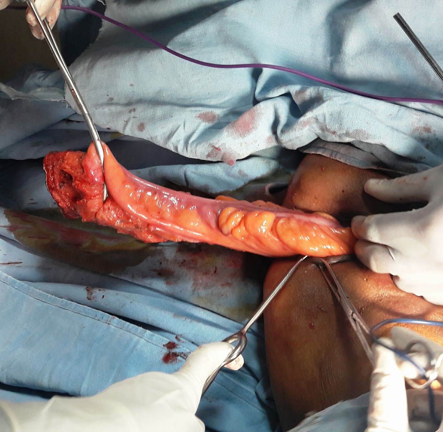 Excised prolapsed rectum and redundant sigmoid colon