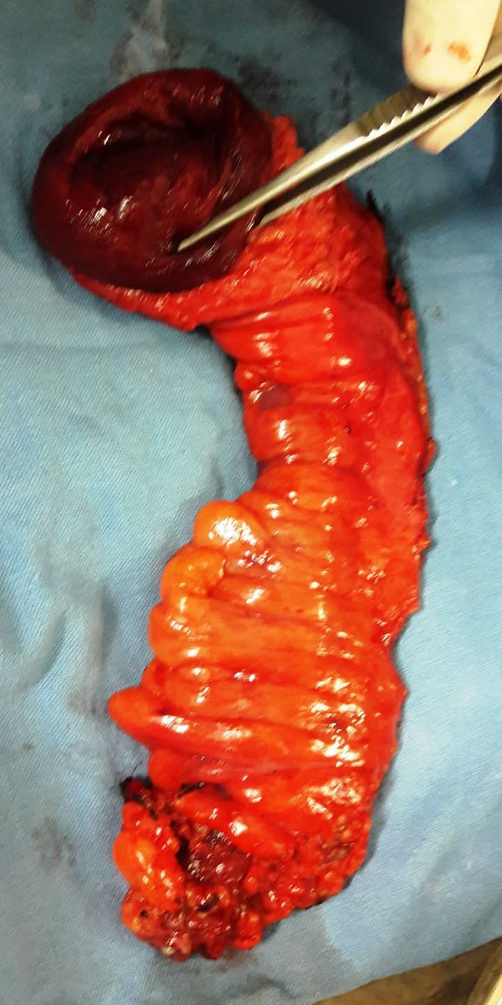 Resected specimen of prolapsed rectosigmoid colon