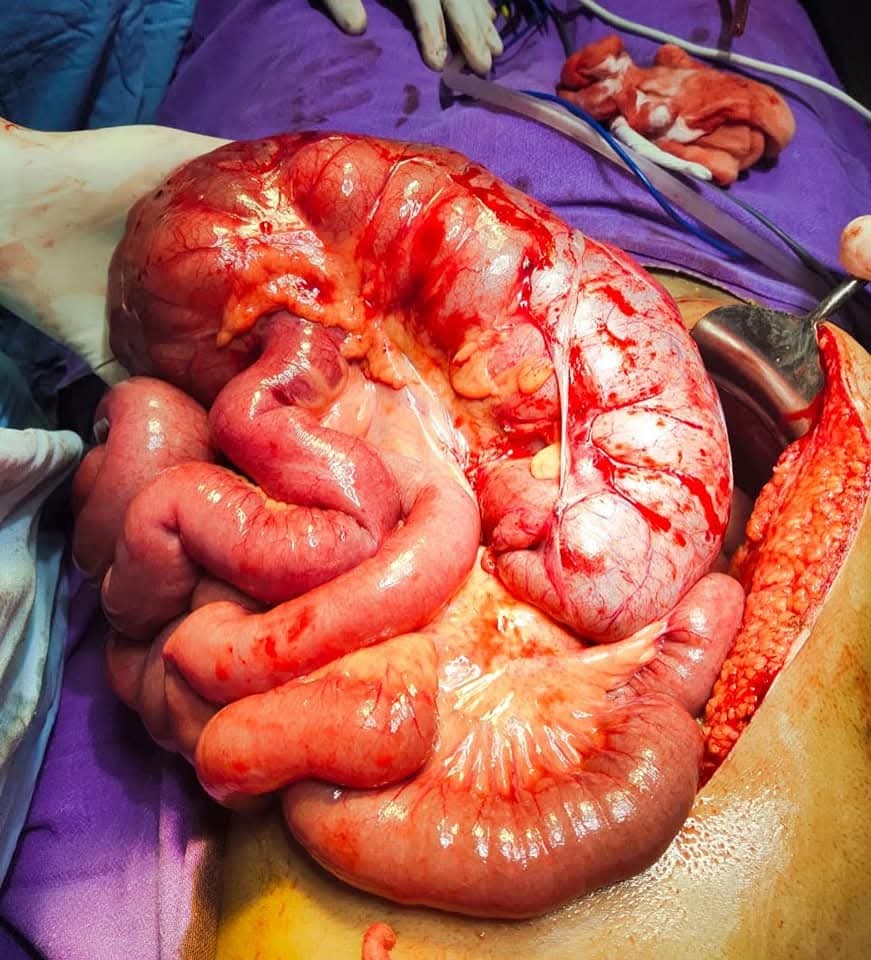 Rare Reverse Rotation of Midgut Causing Acute Large Bowel Obstruction Successfully Treated by Dr. Raman Garg