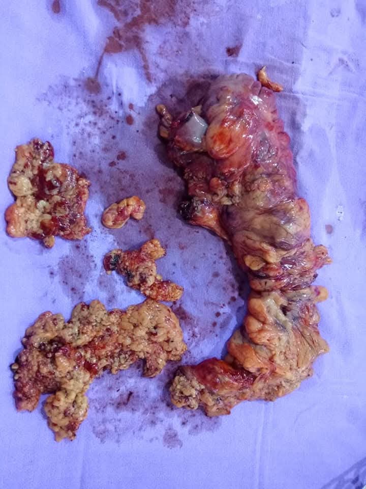 Laparoscopic Extended Right Hemicolectomy for Obstructing Colon Cancer Successfully Performed by Dr. Raman Garg