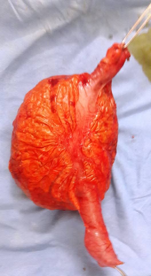 Rare Giant Sigmoid Faecolith Mimicking an Abdominal Tumour Successfully Managed by Dr. Raman Garg