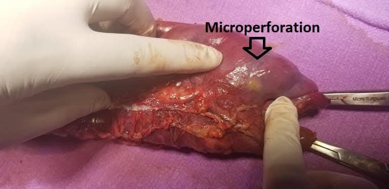 Challenging Case of Sigmoid Colon Stricture with Generalized Peritonitis and Rare Postoperative Gastric Outlet Obstruction Successfully Managed by Dr. Raman Garg