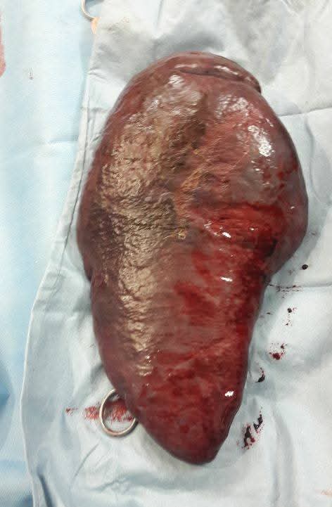 Giant Splenectomy for Massive Splenomegaly with Successful Management of Rare Postoperative Complications by Dr. Raman Garg